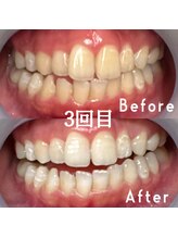 エムラヴィ(M Lavie)/セルフホワイトニング