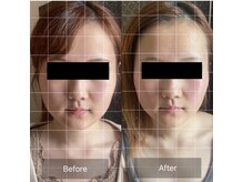 リノリー(rinory)/小顔矯正