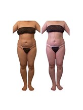 ヴィアス(VIAS)/セルゼロ全身6回目の結果