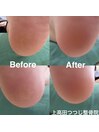 かかとの角質ケア　施術例