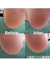 上高田つつじ整体院/かかとの角質ケア　施術例