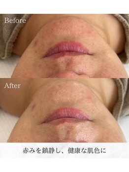 シロ(silo)/健康的な若肌へ♪