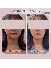 ナチュラ(Natura)/バザルトフェイシャル小顔効果◎