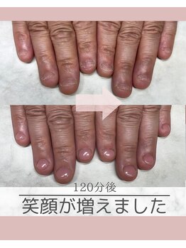 ティアラネイル 宇都宮/深爪矯正