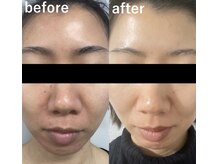 セゾン(Saison)/水光肌ピーリング