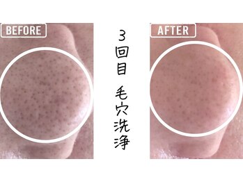 毛穴屋/黒ずみ毛穴もお任せ