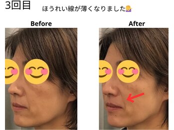 ベル/50代の方の小顔Before After