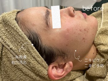 ドクターエイチ 四ツ橋堀江店(Doctor.H)/ハイドロ＋ハーブ＋無針水光注入