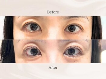 ミューズファクトリー(Muse factory)/マツパのリフトアップ効果♪