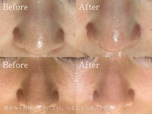 毛穴の黒ずみ・詰まり・開きを、繰り返さない肌へ。