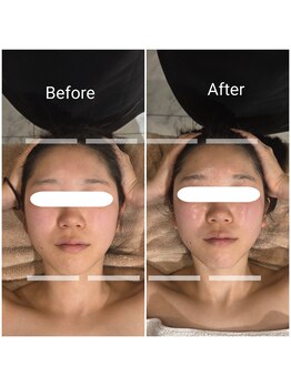 ルナリア ルクス 志木南口駅前店/顔面縮小 小顔リフトアップ施術