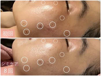 トータルビューティサロン リボーテ(Re:Beaute)の写真/年々増えるシミに終止符を！ダウンタイムの少ないシミケアで、隠す肌から自信の持てる魅せる素肌へ♪