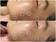 トータルビューティサロン リボーテ(Re:Beaute)の写真/年々増えるシミに終止符を！ダウンタイムの少ないシミケアで、隠す肌から自信の持てる魅せる素肌へ♪
