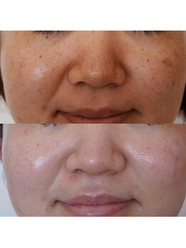 トラット エステアンドアイズ(tratto)/30代前半　お客様症例写真