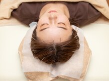 トトノウ(TOTONOU)/頭皮鍼で頭痛とおさらば