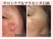 マールム(MALUM)/CMマシーンサーマルbefore/after