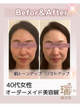 瑞 鍼灸院/美容鍼ビフォーアフター40代