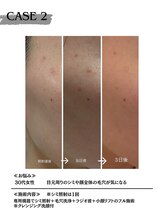 ミウル 天王寺店(miulu)/30代女性/シミ照射1回