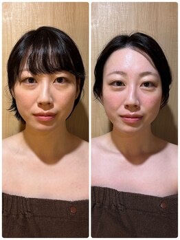 アグレア(Agrea)/頭蓋骨小顔矯正1回の施術♪