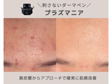 laksmi【肌質改善専門店】毛穴/ニキビケア/赤み/ハーブピーリング/プラズマニアの雰囲気(プラズマジェット×プラズマDDS【2種類のプラズマ使用】)