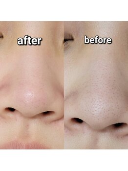 ナオ鍼灸院(Nao鍼灸院)/毛穴洗浄でいちご鼻改善!
