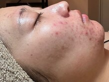 フィール(feel)/Before　期間：1年