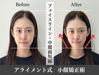 アライメントトウキョウ 表参道(Alignment TOKYO)/フェイスライン改善♪