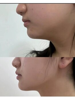 カスミ(KASUMI)/小顔コルギ