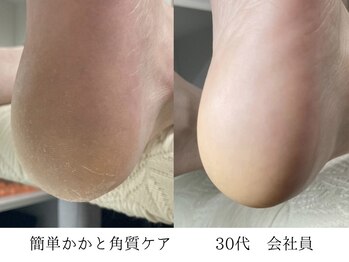 かかと角質ケア
