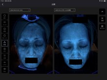 プレジール(Plaisir)/AI肌診断ビフォーアフタ深部シミ