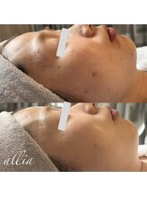 アリア(allia)/ニキビ、肌荒れ