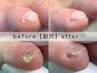 小指爪横の痛みに♪【 副爪 2ヶ所 】気になってた痛みをケア◎初回爪切り無料