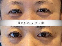 モルティー 宇都宮東店(Molti)/小顔/目元ぱっちり/BTX