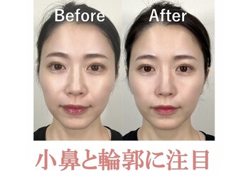 隆鼻矯正専門店 ラプリ(Raplit)/隆鼻＋輪郭矯正40分1回