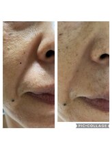 ミエル(Miel)/Before After