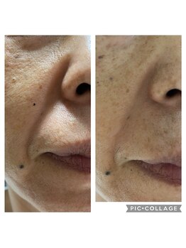 ミエル(Miel)/Before After