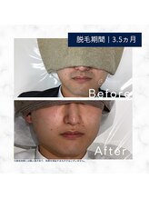 メンズクリア 武蔵小杉店/【メンズクリア】お客様の施術例
