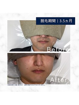 メンズクリア 武蔵小杉店/【メンズクリア】お客様の施術例