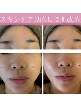 ミエル(miel)/【ハーブピーリング】毛穴ケア