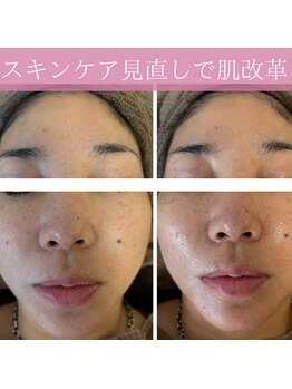 ミエル(miel)/【ハーブピーリング】毛穴ケア