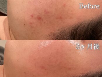 ポポラス(POPOLUS)/ニキビケア3ヶ月