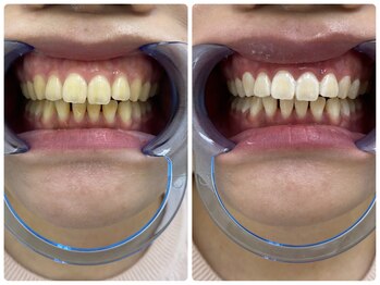 エクシアホワイトニング 日本橋店/ビフォアフ