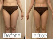 ホリスティックラボ(Holistic Labo)/Before & After (太もも)