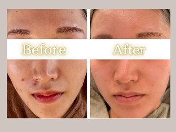 ハル(HARU.)/美肌プログラム5回