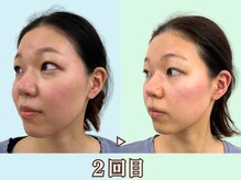 ナチュラルビューティーフェイス 横浜(NBF)/結婚式の写真は小顔で