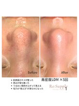 リサプリ(Re: Supple)/毛穴の黒ずみ・開き・ざらつきに