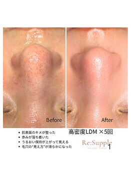 リサプリ(Re: Supple)/毛穴の黒ずみ・開き・ざらつきに