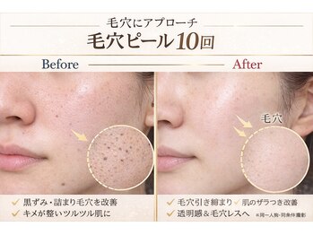 カラン(CALIN)の写真/【毛穴レスな美肌を目指す！】毛穴の開き・黒ずみ・詰まり等、毛穴悩みは人それぞれ…毛穴洗浄で徹底改善◎