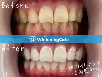 ホワイトニングカフェ 松本店(WhiteningCafe)/ホワイトニングビフォーアフター