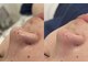 アルリシャ(Alrescha)の写真/毛穴エクストラクションで汚れをスッキリ整えて、透明感溢れる素肌を手に入れる体験をぜひ♪